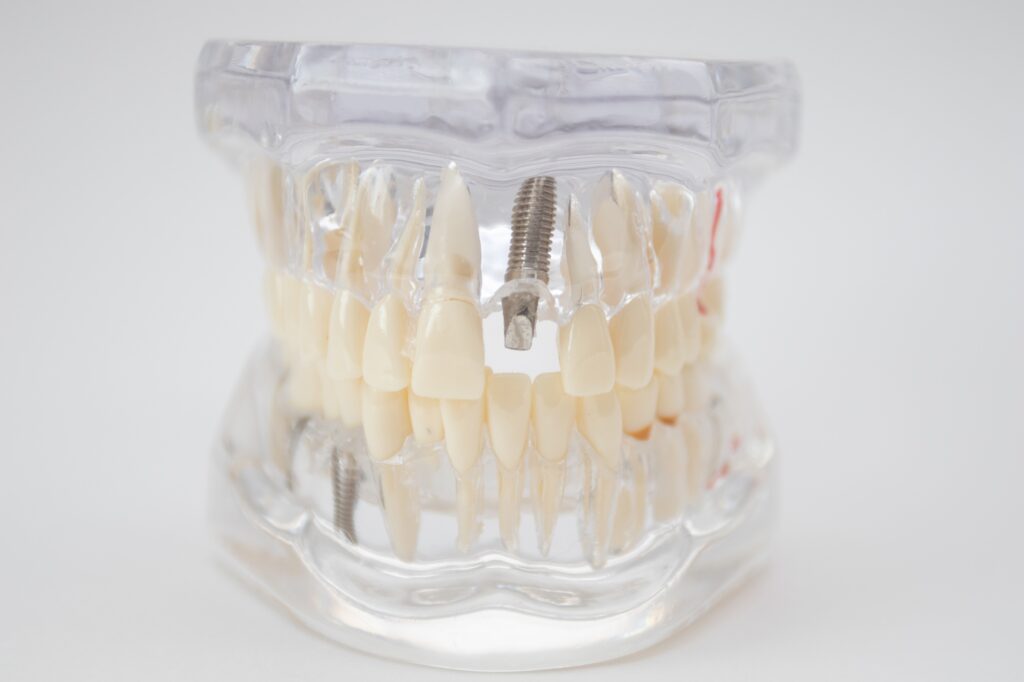 A demonstration jaw with an implant and an abutment