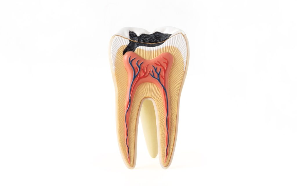 Isolated photo of internal tooth structure model with caries destruction on white background